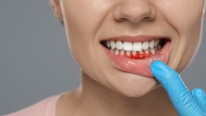 Affordable Gum Disease Treatment in Shanghai with PureSmile Shanghai