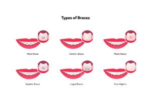 Types of Adult Braces: Which Option is Right for You? | PureSmile Shanghai