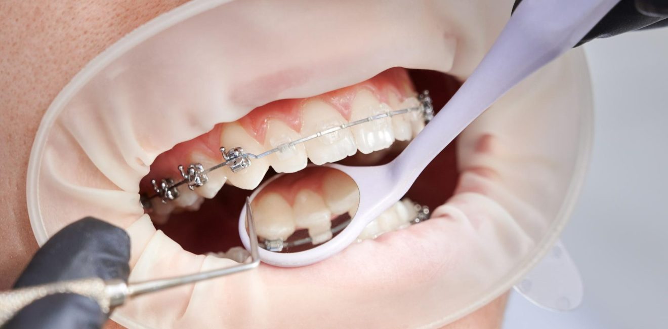 ceramic braces shanghai