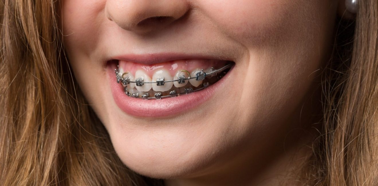 metal braces shanghai