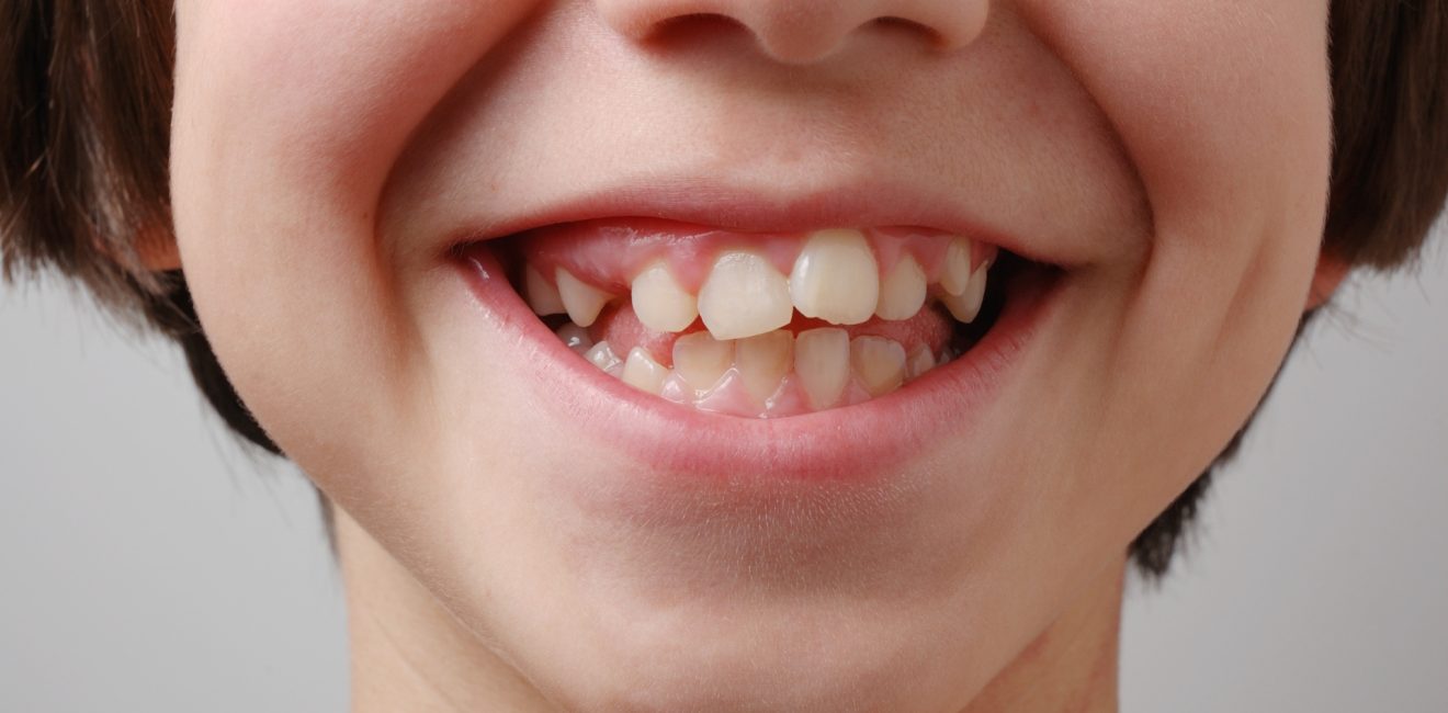 Crooked Teeth