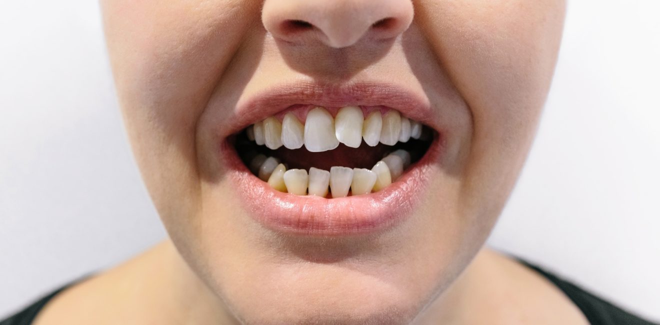 Crooked Teeth