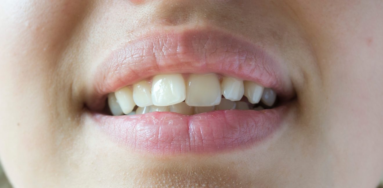 Crooked Teeth