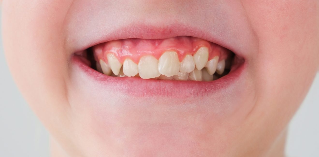 Crooked Teeth
