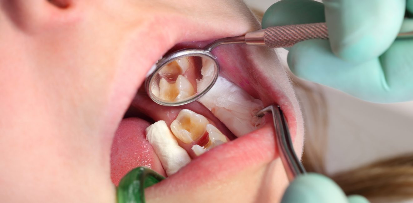 Dental Cavity