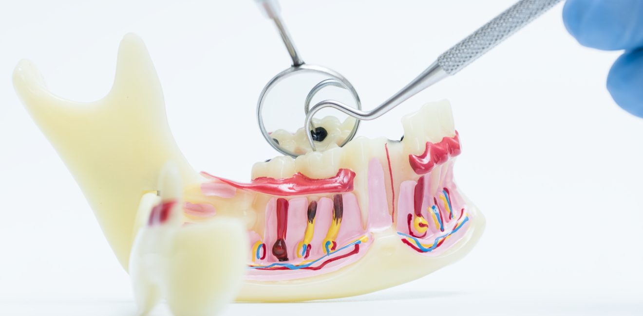 Dental Cavity