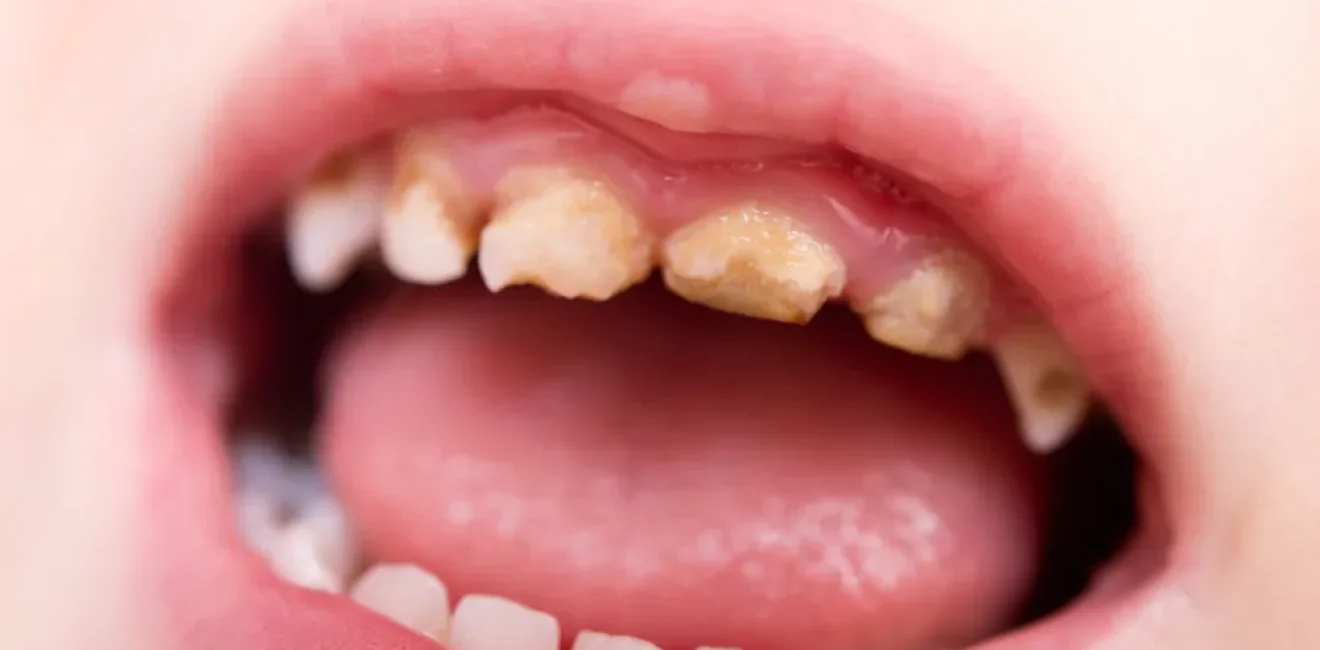 baby bad teeth