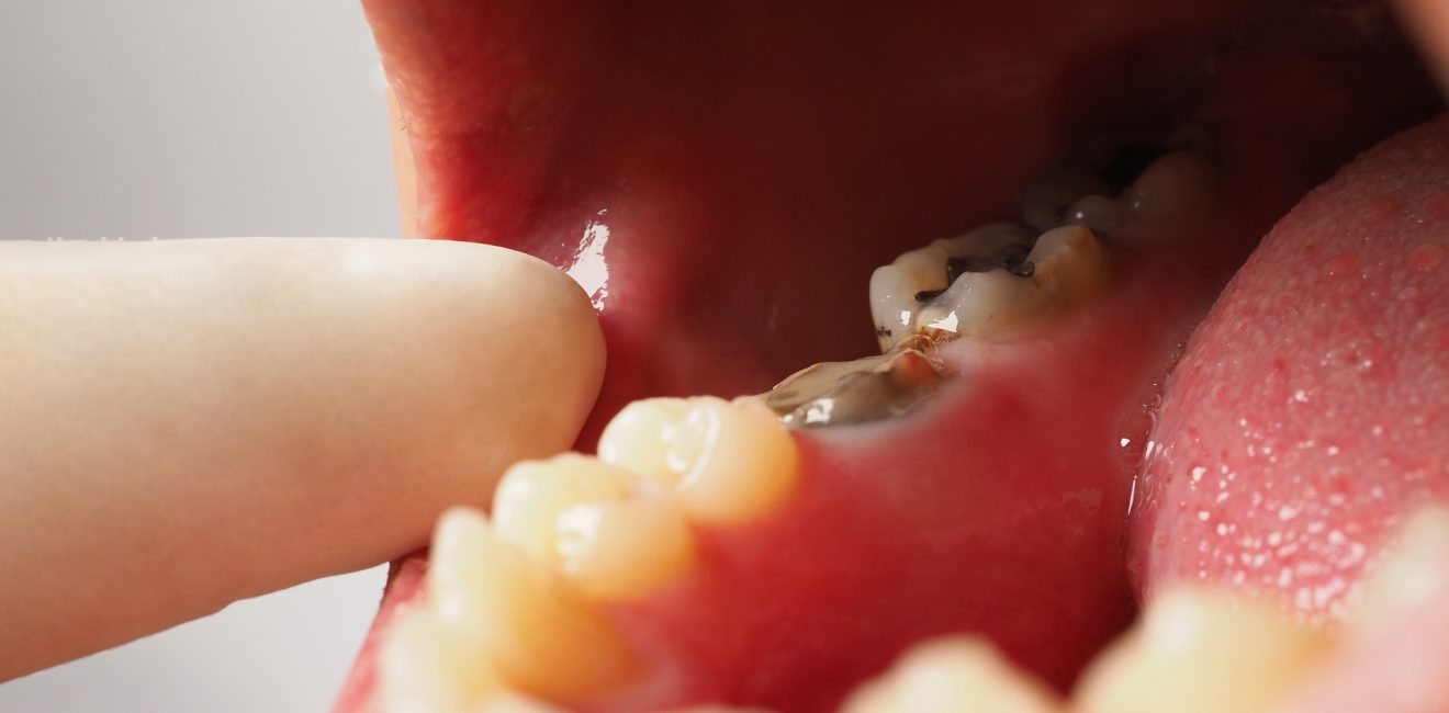 cosmetic dentistry for tooth decay shanghai